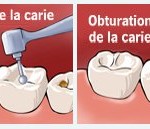 carie1